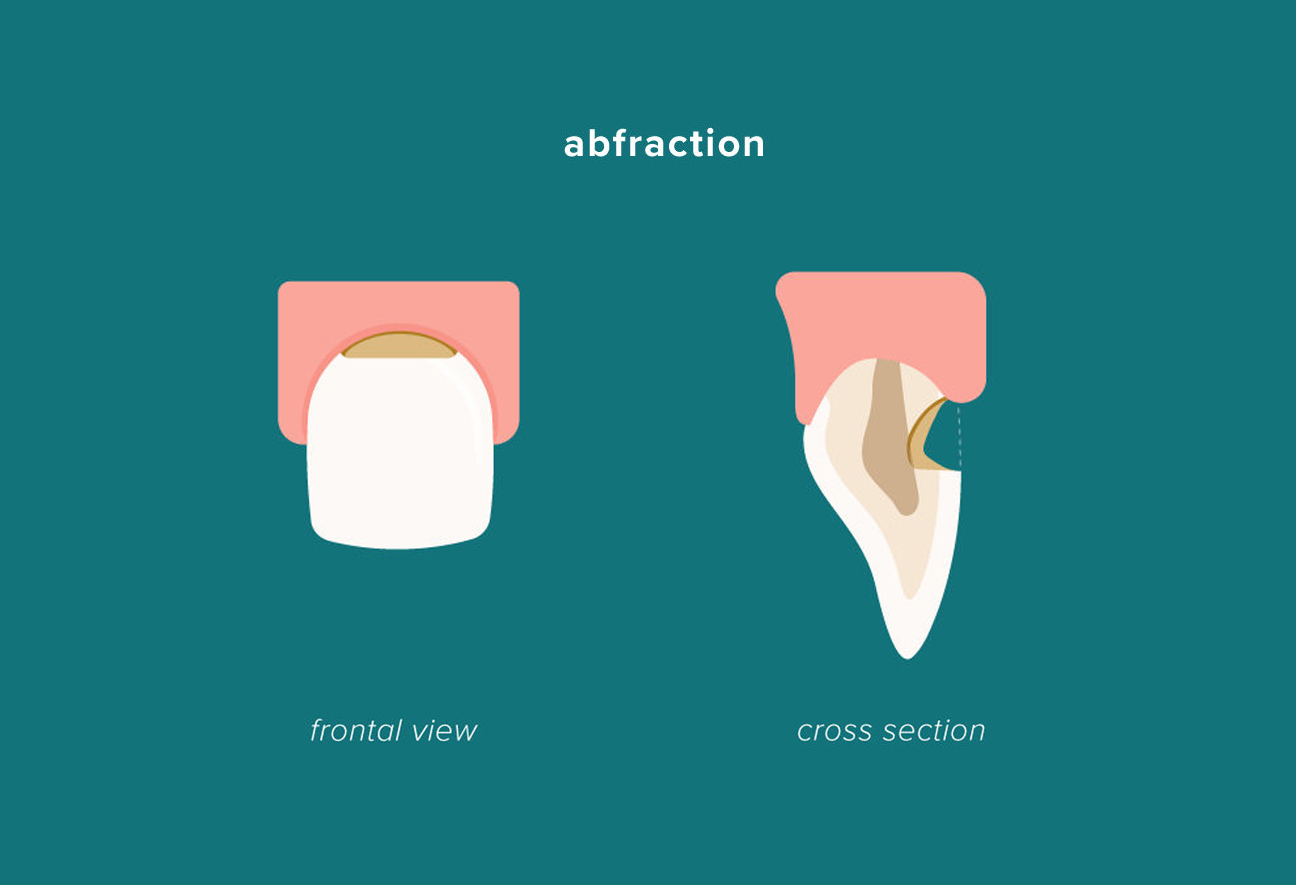 Abfraction A New Dental Term Omni Dental Austin Dental Group Omni Dental Group Dr. Marc