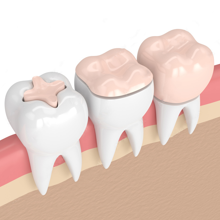 dental sealant