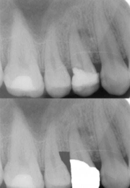 crown lengthening